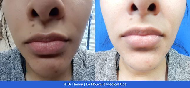 lip enhancement before and after with juvederm and volbella, oxnard