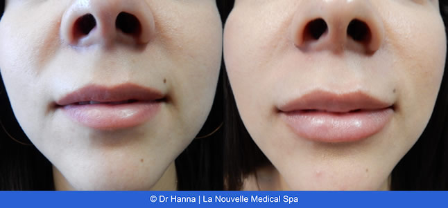 lip enhancement before and after with juvederm and volbella, oxnard