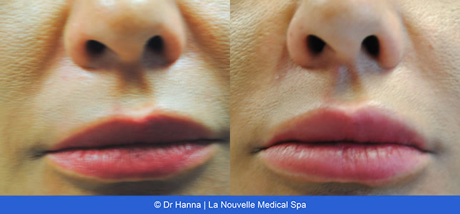 lip enhancement before and after with juvederm and volbella, oxnard