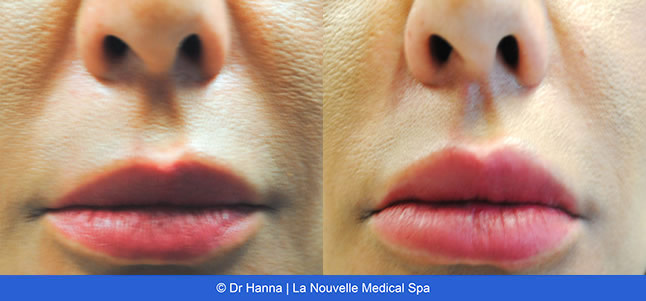 lip enhancement before and after with juvederm and volbella, oxnard