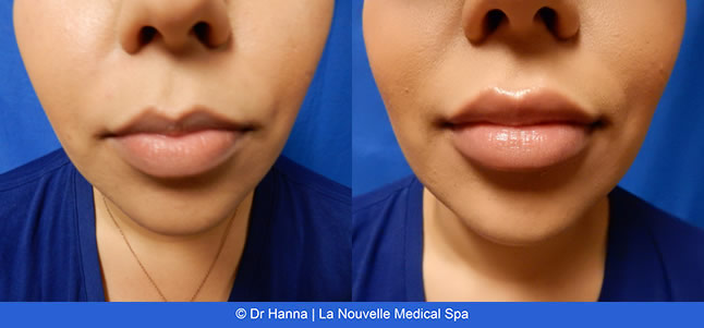 lip enhancement before and after with juvederm and volbella, oxnard