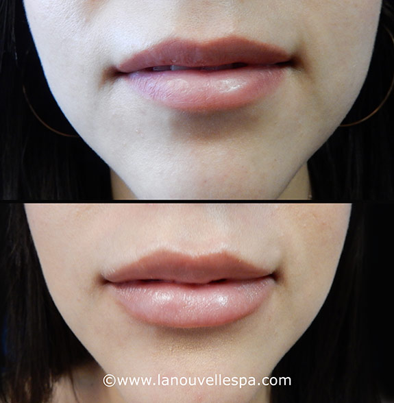 lip enhancement before and after with juvederm and volbella, oxnard