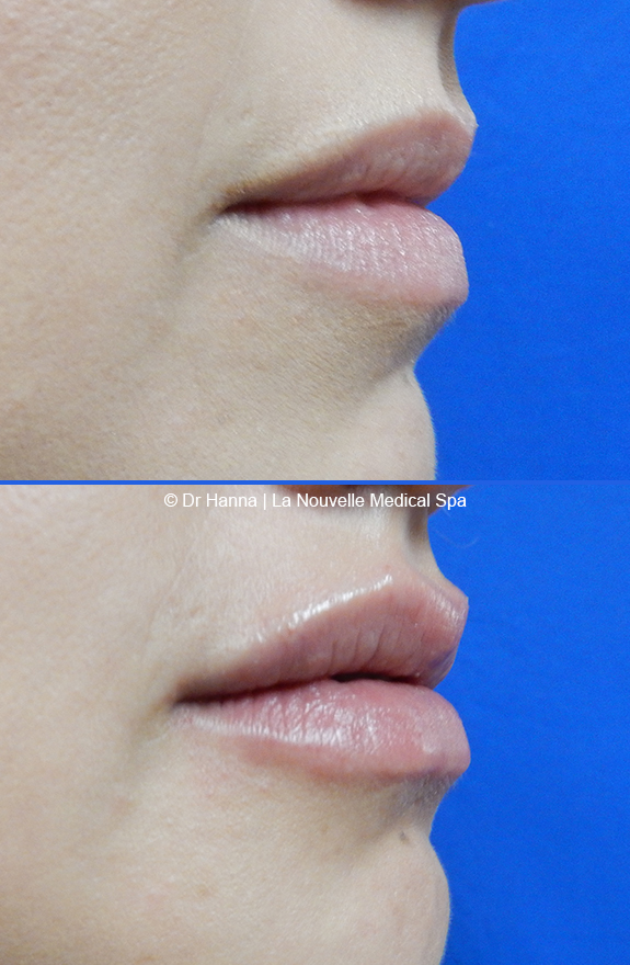 lip enhancement before and after with juvederm and volbella, oxnard