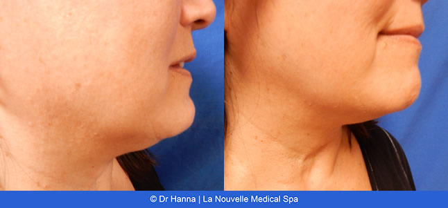 kybella injections for double chin before after photos, La Nouvelle Medical Spa, Oxnard, Ventura County