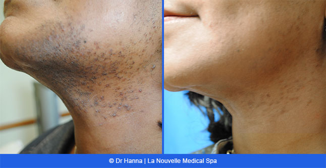 Laser hair removal treatments before and after Ventura County, La Nouvelle Medical Spa, Oxnard