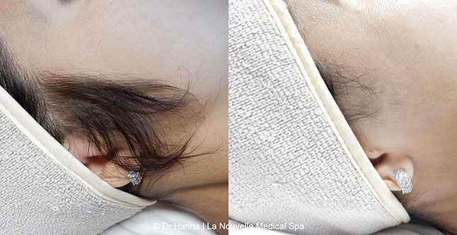 Laser hair removal treatments before and after Ventura County, La Nouvelle Medical Spa, Oxnard