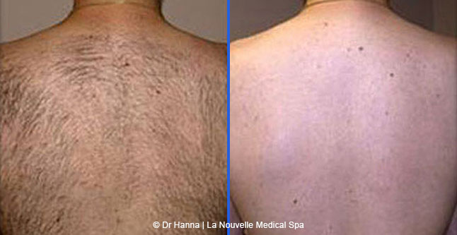 Laser hair removal treatments before and after Ventura County, La Nouvelle Medical Spa, Oxnard