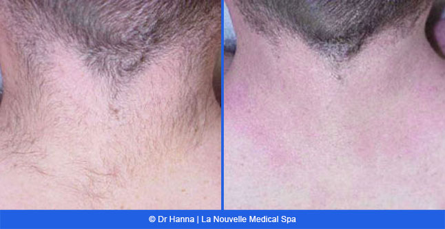 Laser hair removal treatments before and after Ventura County, La Nouvelle Medical Spa, Oxnard