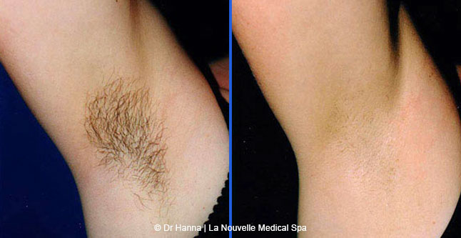 Laser hair removal treatments before and after Ventura County, La Nouvelle Medical Spa, Oxnard