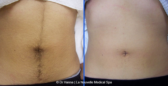 Laser hair removal treatments before and after Ventura County, La Nouvelle Medical Spa, Oxnard