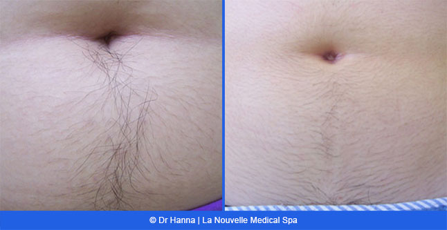 Laser hair removal treatments before and after Ventura County, La Nouvelle Medical Spa, Oxnard