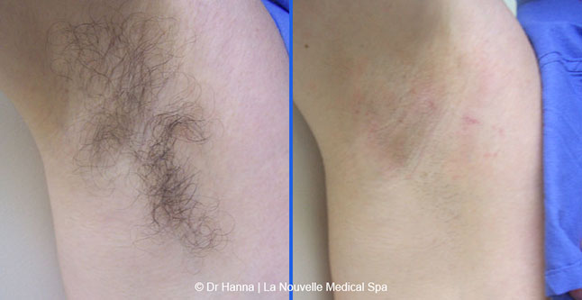 Laser hair removal treatments before and after Ventura County, La Nouvelle Medical Spa, Oxnard