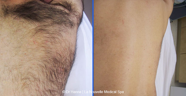 Laser hair removal treatments before and after Ventura County, La Nouvelle Medical Spa, Oxnard