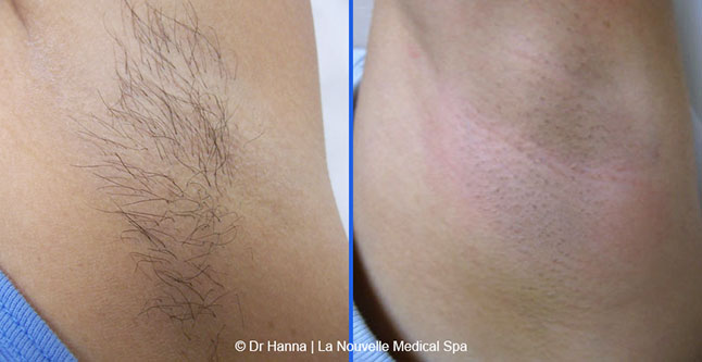 Laser hair removal treatments before and after Ventura County, La Nouvelle Medical Spa, Oxnard
