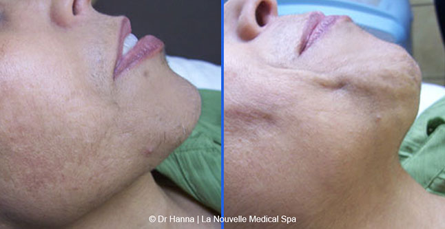 Laser hair removal treatments before and after Ventura County, La Nouvelle Medical Spa, Oxnard
