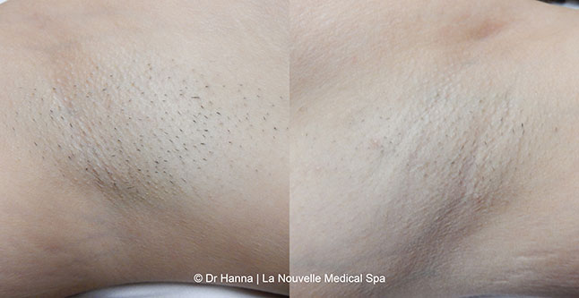 Laser hair removal treatments before and after Ventura County, La Nouvelle Medical Spa, Oxnard