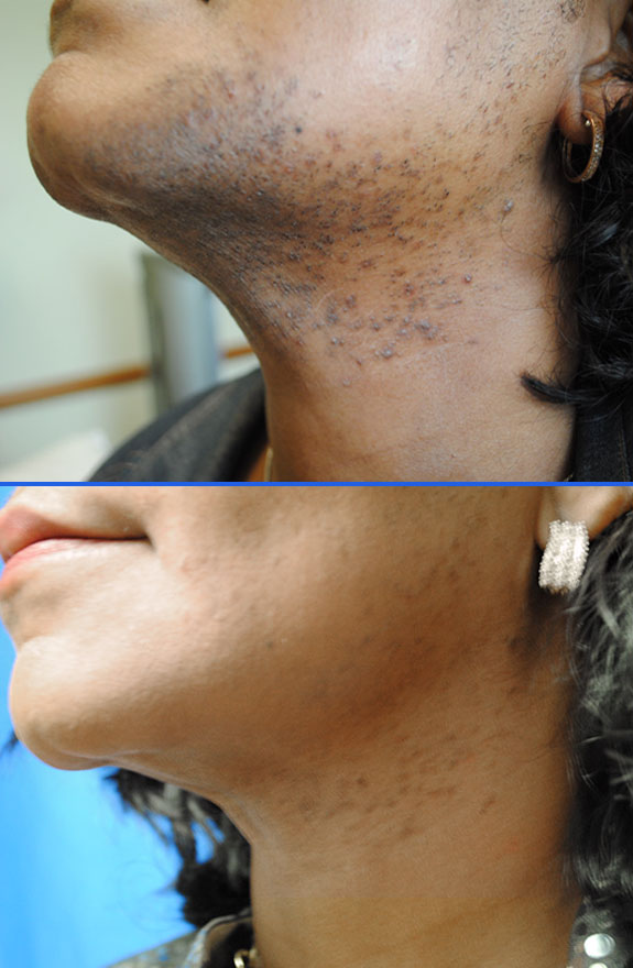 laser hair removal chin before after photos, La Nouvelle Medical Spa, Oxnard, Ventura county