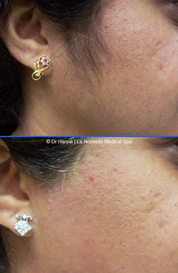 laser hair removal on cheek before after photos, La Nouvelle Medical Spa, Oxnard, Ventura county
