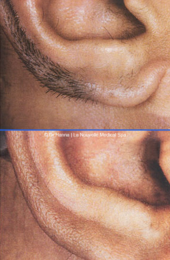 laser hair removal on ears before after photos, La Nouvelle Medical Spa, Oxnard, Ventura county