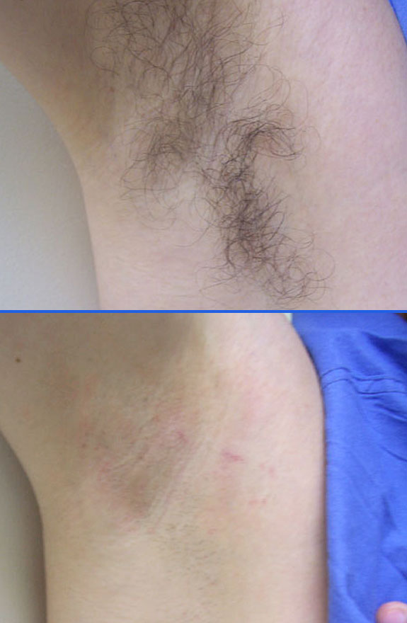 laser hair removal armpit before after photos, La Nouvelle Medical Spa, Oxnard, Ventura county