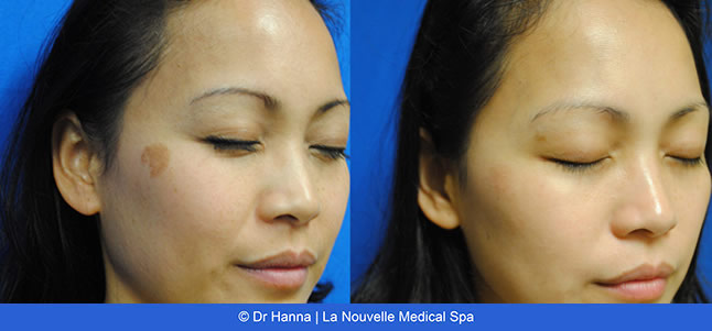 Laser IPL Obagi before & after images