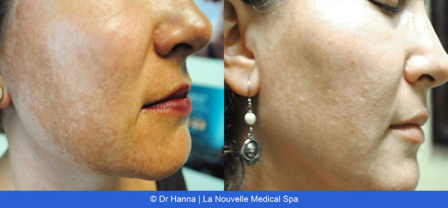 Laser IPL Obagi before & after images