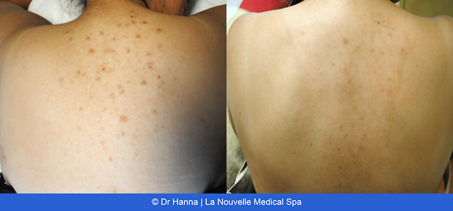 Laser IPL Obagi before & after images