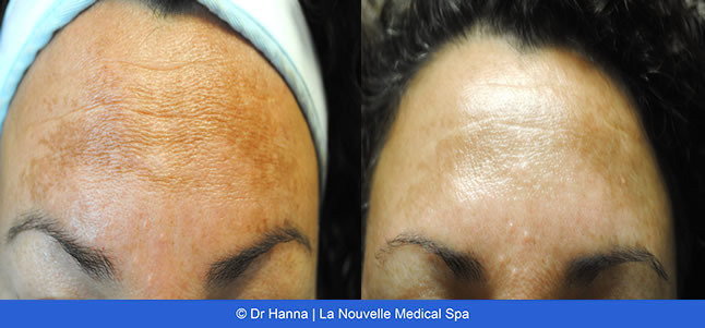 Laser IPL Obagi before & after images
