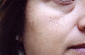 Laser IPL - after