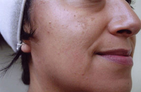 Laser IPL - before