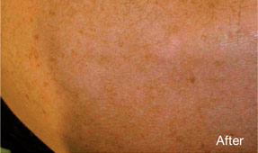 Laser IPL - after