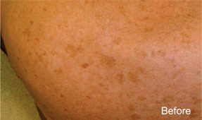 Laser IPL - before