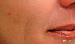 Laser IPL - after