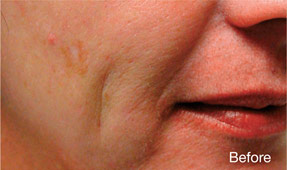 Laser IPL - before
