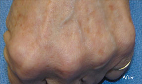 Laser IPL - age spots after, dr antoine hanna, oxnard, ventura county