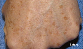 Laser IPL - age spots before, dr antoine hanna, oxnard, ventura county