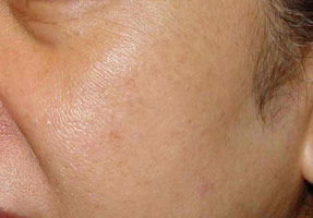 Laser IPL - after