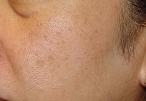 Laser IPL - before