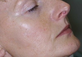 Laser IPL - after