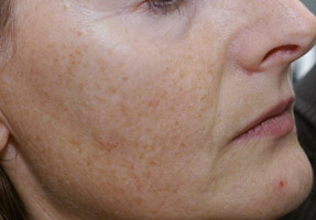 Laser IPL - before