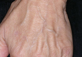 Laser IPL - after