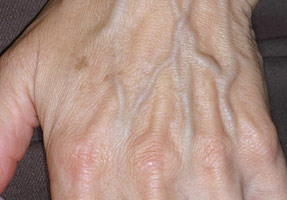 Laser IPL - before