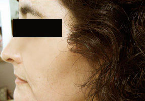 Laser IPL - after