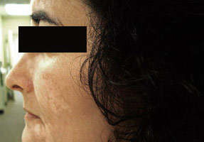 Laser IPL - before