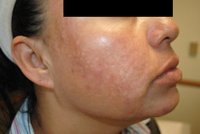 Laser IPL - after