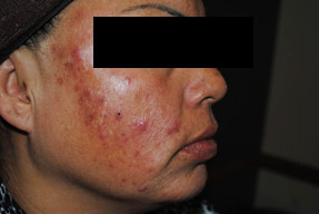 Laser IPL - before