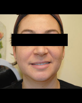 Laser IPL - after