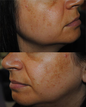 Laser IPL - before