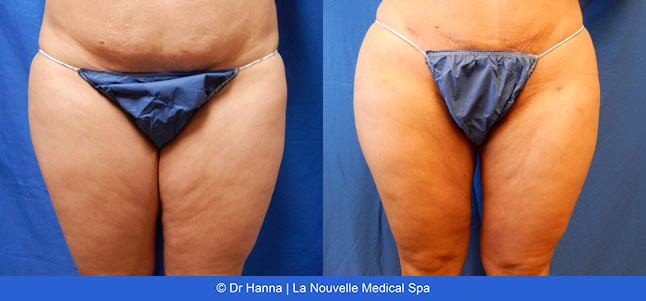 Liposuction, Smartlipo before after photos Ventura County, Dr. Hanna La Nouvelle Medical Spa, Oxnard