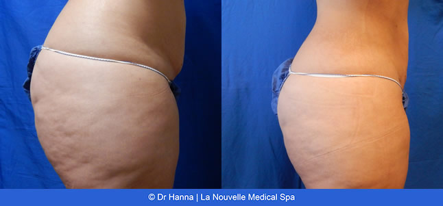 Liposuction, Smartlipo before after photos Ventura County, Dr. Hanna La Nouvelle Medical Spa, Oxnard